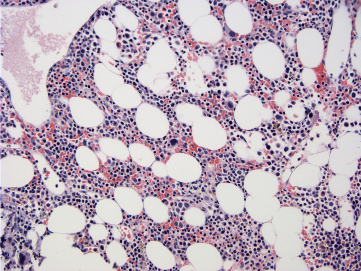 Bone marrow core biopsy section (BM-2), H&E stain, x200